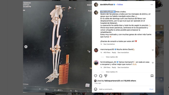 Pebalap Ini Alami Patah Tulang Paha Usai Crash di GP Mandalika, Bagaimana Nasibnya?